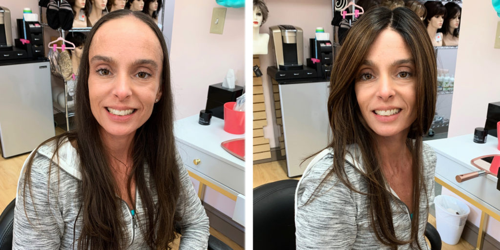 toppers for alopecia before and after
