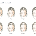 topper for receding hairline